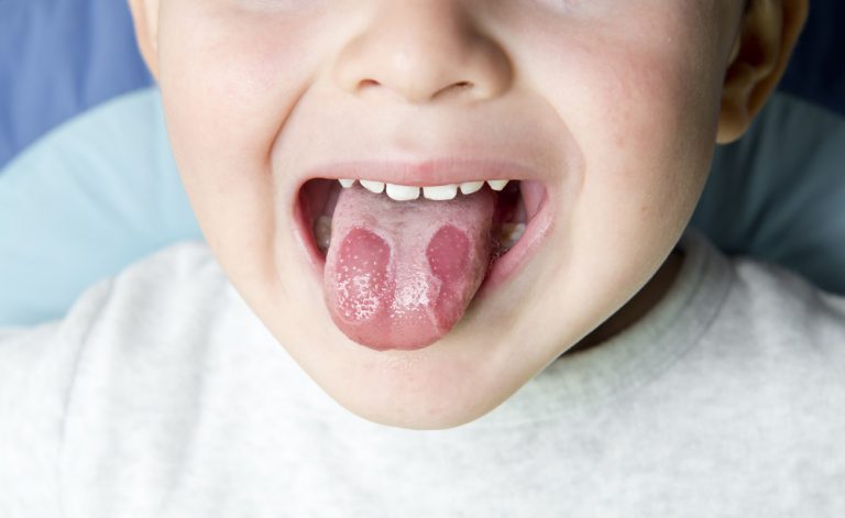 As causas desses dolorosos cortes na língua
