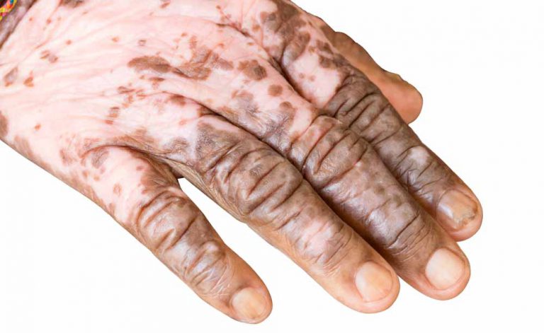 Albinismo e vitiligo: as características das doenças